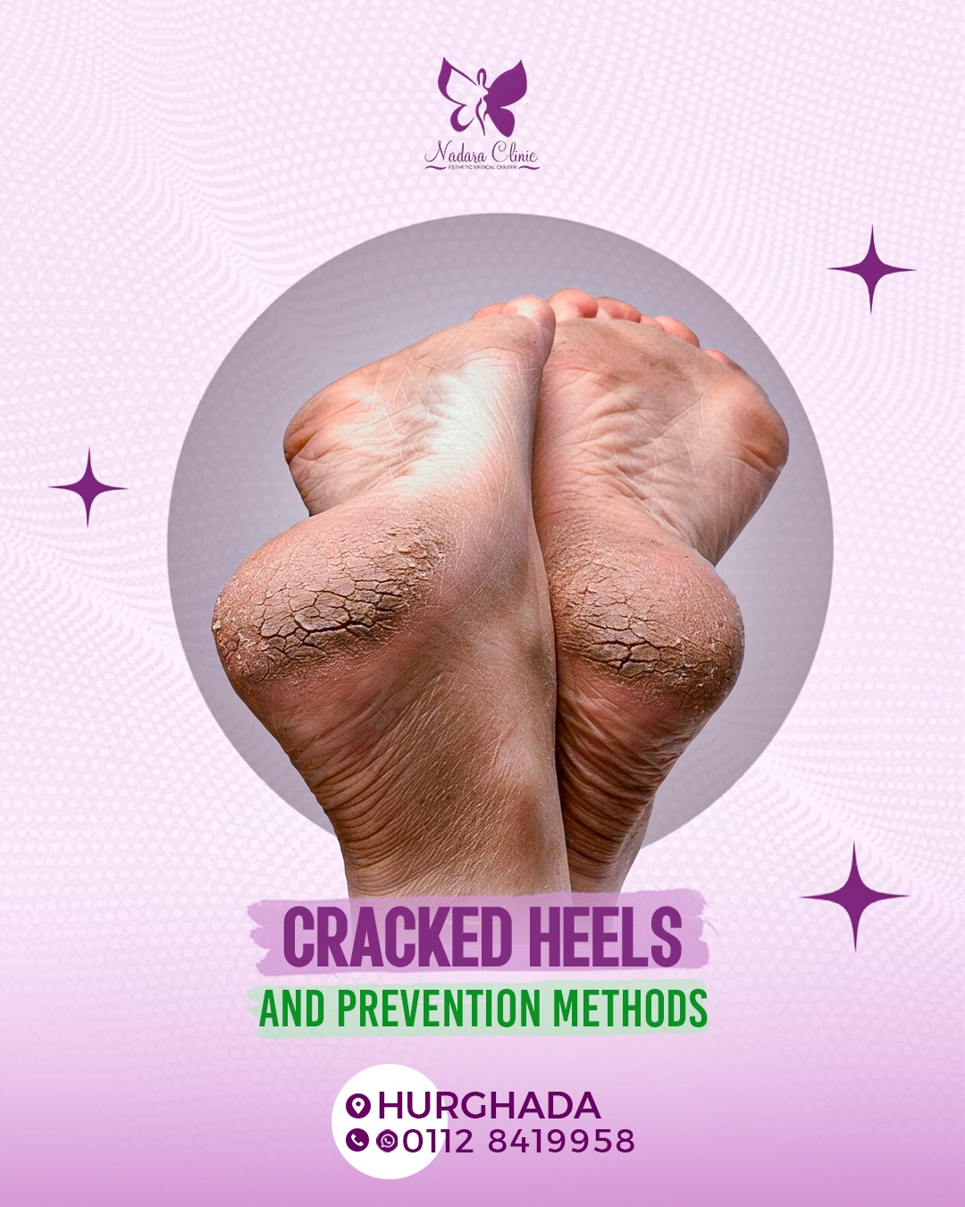 Foot cracks and prevention methods in Hurghada